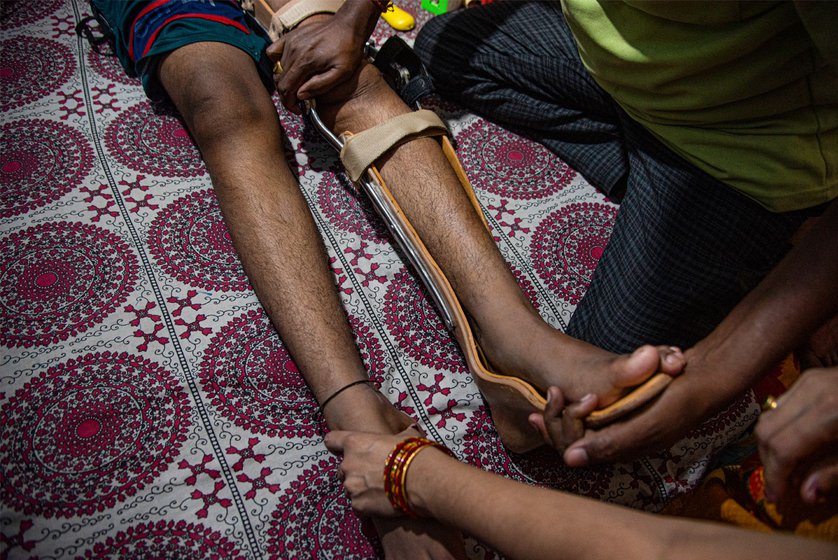 Right: Avik's lost the ability to walk when he got bone TB, but now is better with treatment. In the photo his father is helping him wear a walking brace