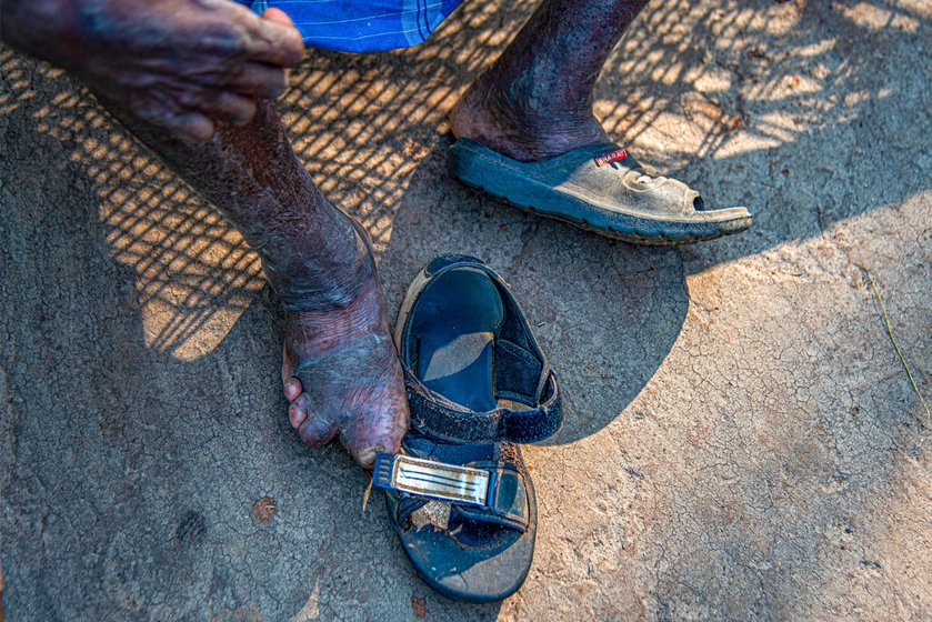 Right: Sabar Mallick is a resident of Singdhui and in the advanced stages of leprosy. He says the state offered no treatment for it